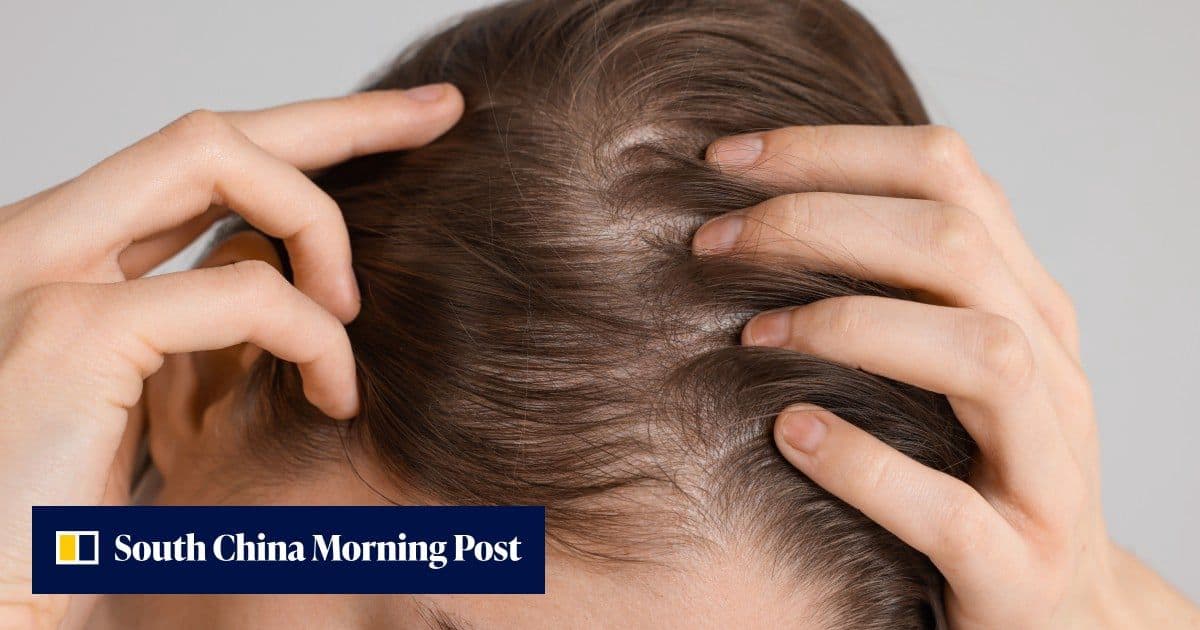 Arthritis drug restores 100% hair on 1 in 5 alopecia patients in global trial
